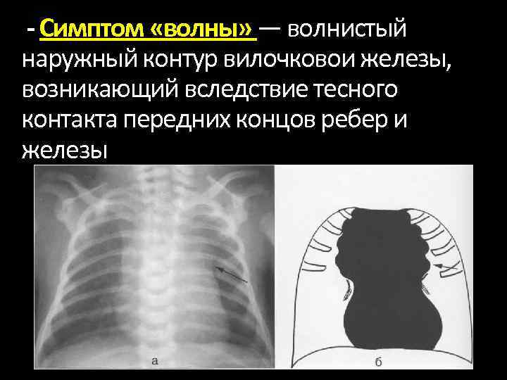 - Симптом «волны» — волнистый наружный контур вилочковои железы, возникающий вследствие тесного контакта передних