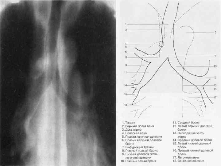 Анатомия рентген. Анатомия средостения рентген. Средостение ретнгенанатомия. Анатомия средостения на рентгенограмме. Границы средостения на рентгенограмме.