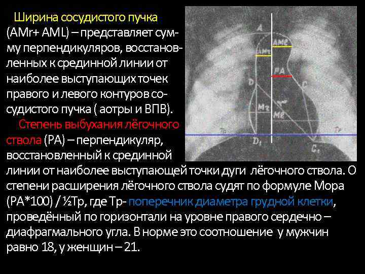 Сосудистый пучок. Ширина сосудистого пучка. Сосудистый пучок на рентгенограмме. Поперечник сосудистого пучка в норме. Сосудистый пучок сердца на рентгенограмме.