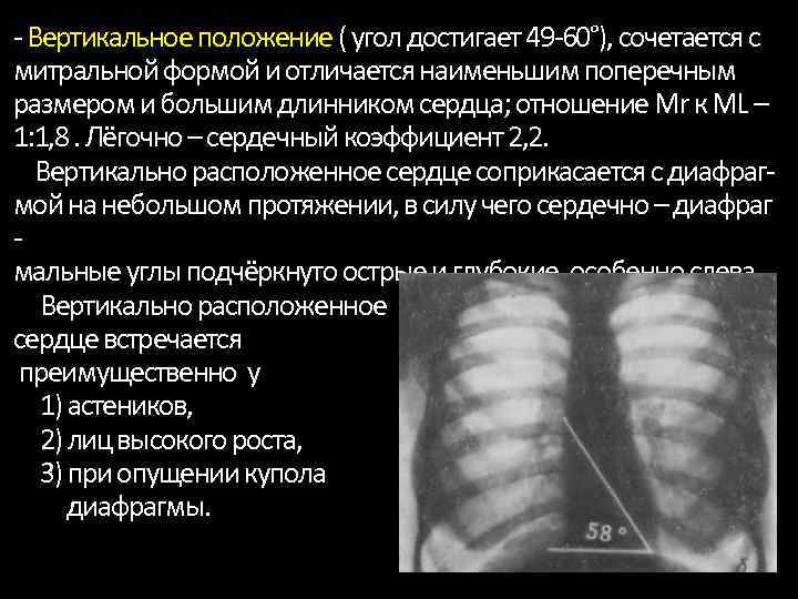 Длинник сердца. Вертикальное положение сердца на рентгенограмме. Длинник сердца на рентгенограмме. Горизонтальное положение сердца на рентгенограмме. Поперечный диаметр сердца рентген.