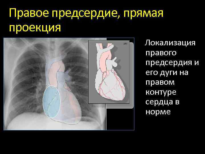 Правое предсердие, прямая проекция Локализация правого предсердия и его дуги на правом контуре сердца