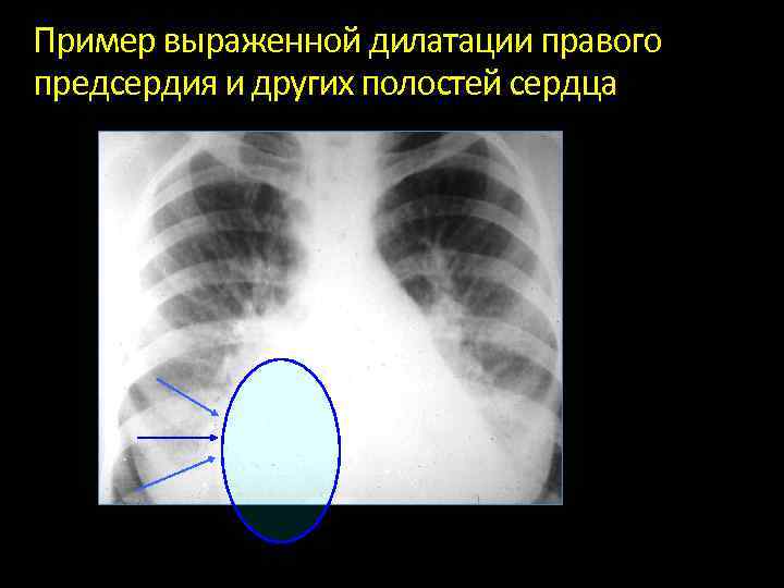 Увеличение правого. Дилатация сердца рентген. Увеличение правого предсердия на рентгенограмме. Рентгенография дилатация камер сердца. Расширение правых отделов сердца рентген.