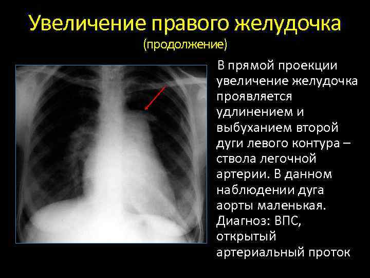 Увеличение правого желудочка (продолжение) В прямой проекции увеличение желудочка проявляется удлинением и выбуханием второй