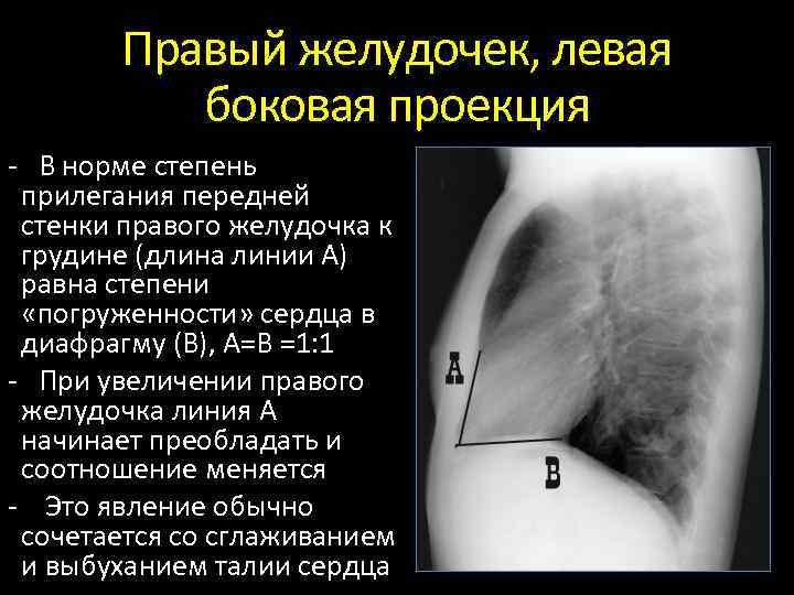 Увеличение правого