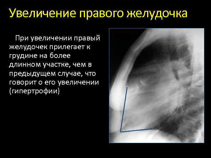 Анатомия рентген. Анатомия грудины рентген. Увеличение ретростернального пространства. Грудина анатомия рентген. Ретростернальное пространство на рентгене.