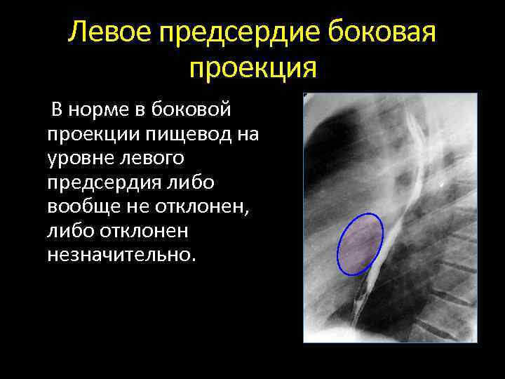 Левое предсердие боковая проекция В норме в боковой проекции пищевод на уровне левого предсердия