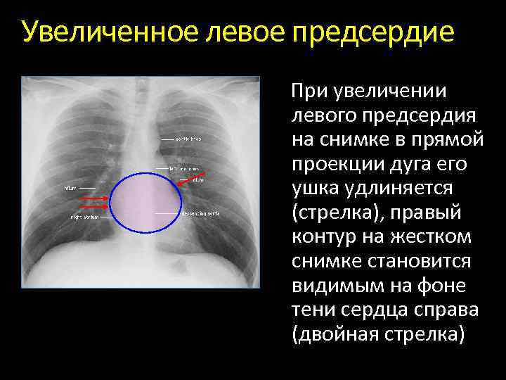 Увеличенное левое предсердие При увеличении левого предсердия на снимке в прямой проекции дуга его