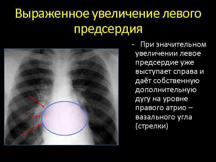 Выраженное увеличение левого предсердия При значительном увеличении левое предсердие уже выступает справа и даёт