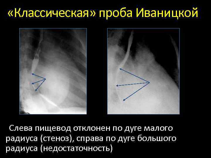  «Классическая» проба Иваницкой Слева пищевод отклонен по дуге малого радиуса (стеноз), справа по