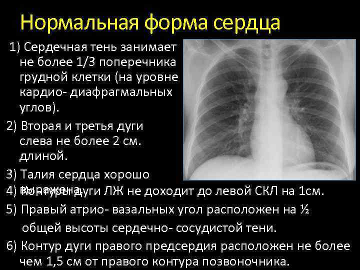 Границы расширены влево. Форма средостения на рентгене. Нормальная конфигурация сердца рентген. Рентген грудной клетки норма. Тень сердца на рентгенограмме в норме.