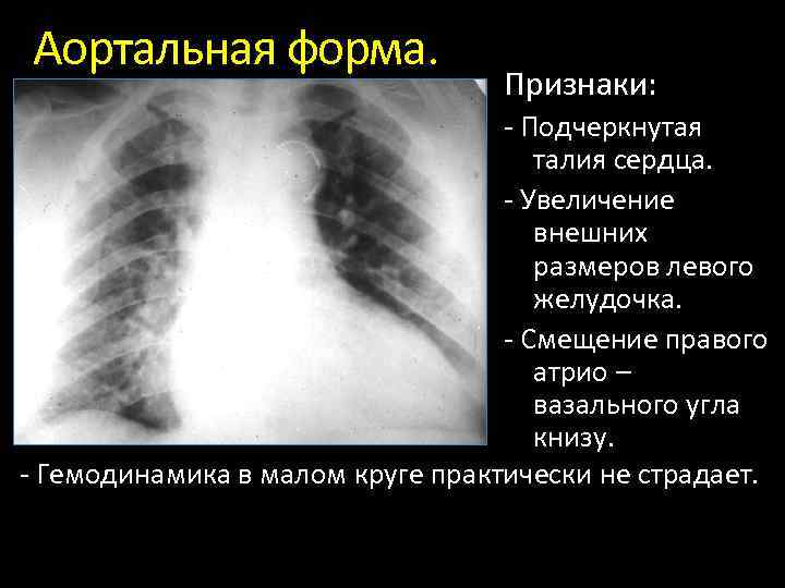 Аортальная форма. Признаки: Подчеркнутая талия сердца. Увеличение внешних размеров левого желудочка. Смещение правого атрио