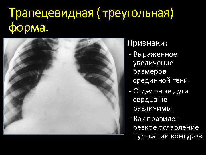 Трапецевидная ( треугольная) форма. Признаки: Выраженное увеличение размеров срединной тени. Отдельные дуги сердца не