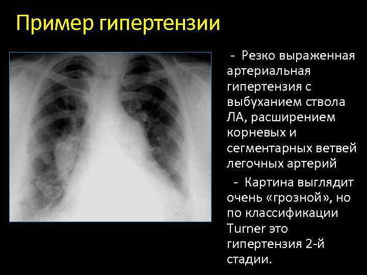 Ампутация корней легких при рентгенологической картине характерна для