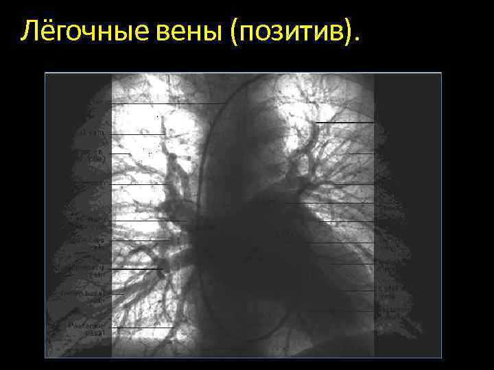 Легочных венах. Анатомия средостения рентген. Нижняя полая Вена на рентгенограмме.