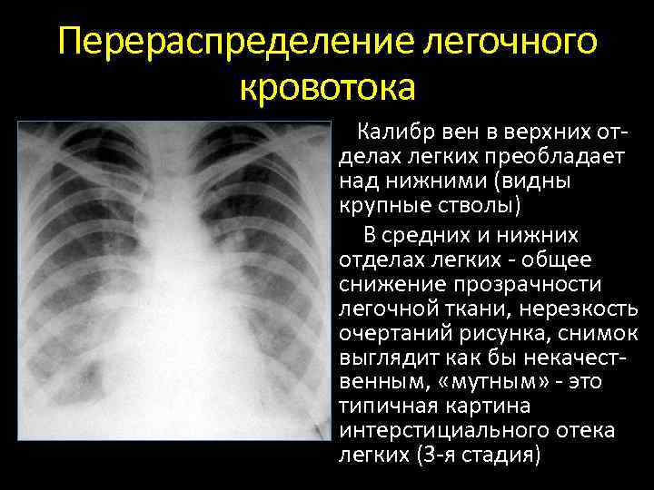 Усиление легочного рисунка за счет интерстициального компонента