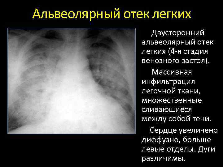 Отек легких рентгенологическая картина