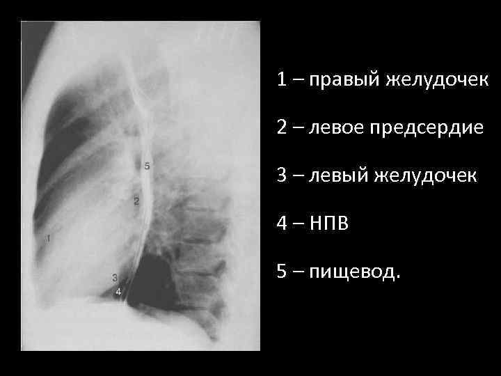 1 – правый желудочек 2 – левое предсердие 3 – левый желудочек 4 –