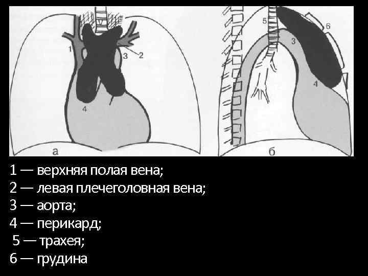 Схема расположения органов средостения