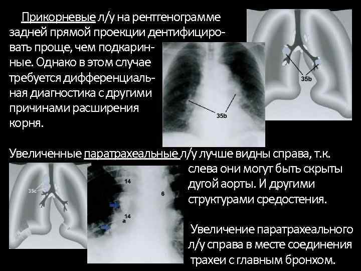 Прикорневые л/у на рентгенограмме задней прямой проекции дентифициро вать проще, чем подкарин ные. Однако