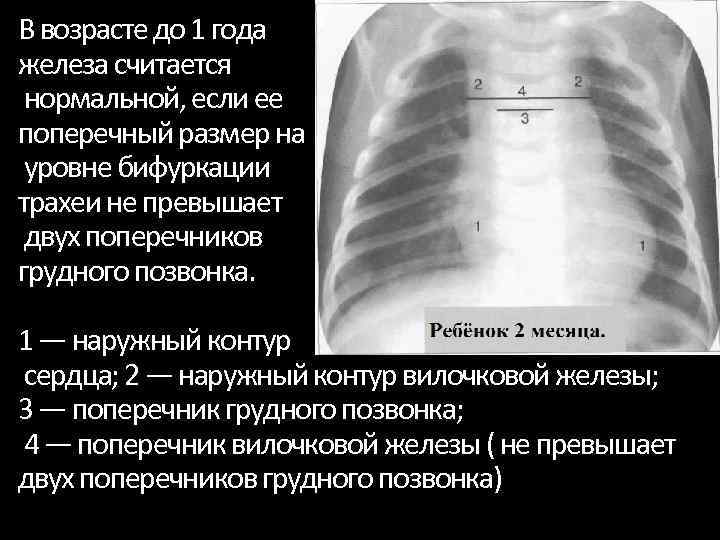 В возрасте до 1 года железа считается нормальной, если ее поперечный размер на уровне