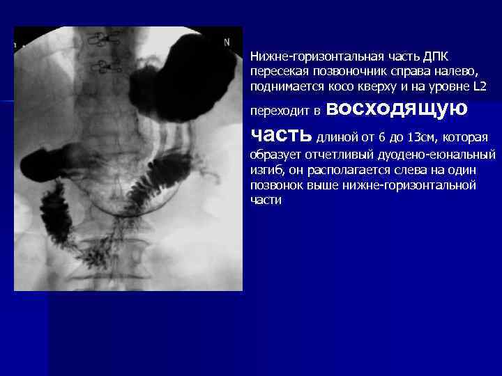  Нижне-горизонтальная часть ДПК пересекая позвоночник справа налево, поднимается косо кверху и на уровне