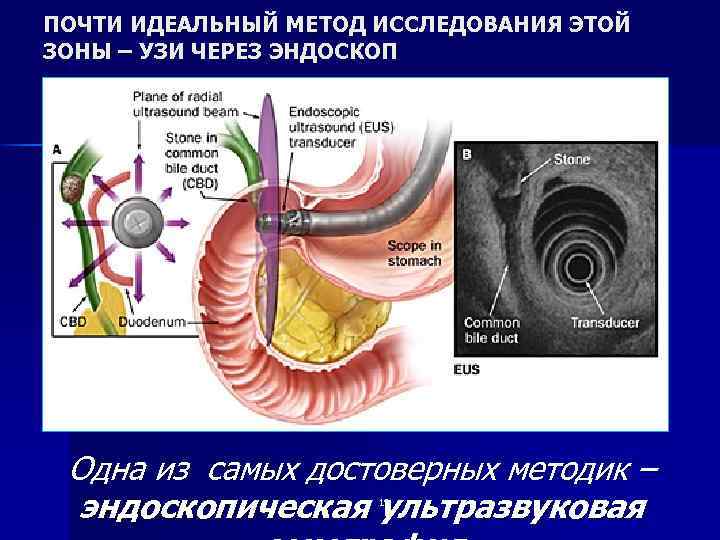 ПОЧТИ ИДЕАЛЬНЫЙ МЕТОД ИССЛЕДОВАНИЯ ЭТОЙ ЗОНЫ – УЗИ ЧЕРЕЗ ЭНДОСКОП Одна из самых достоверных