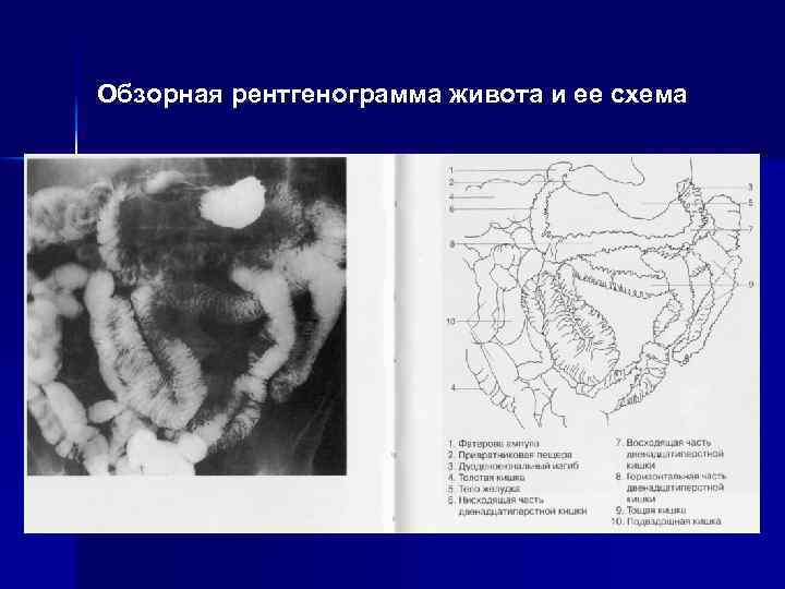 Обзорная рентгенограмма живота и ее схема 