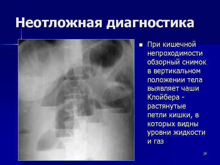 О кишечная непроходимость карта вызова