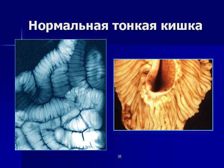 Нормальная тонкая кишка 28 