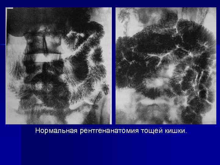 Нормальная рентгенанатомия тощей кишки. 