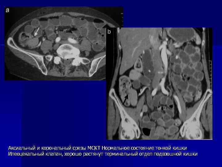 Аксиальный и корональный срезы МСКТ Нормальное состояние тонкой кишки Илеоцекальный клапан, хорошо растянут терминальный