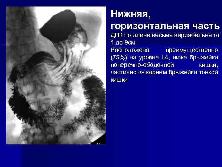 Нижняя, горизонтальная часть ДПК по длине весьма вариабельна от 1 до 9 см Расположена