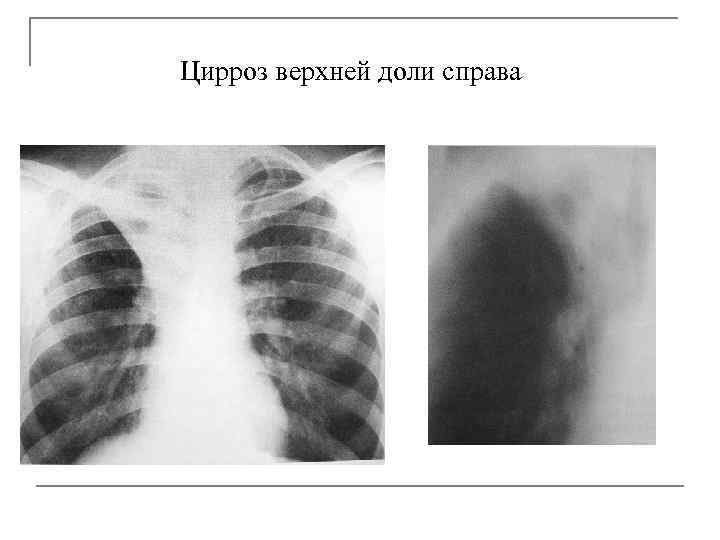 Цирроз верхней доли справа 