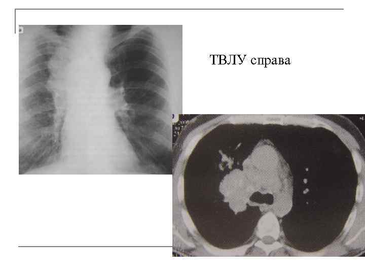 ТВЛУ справа 