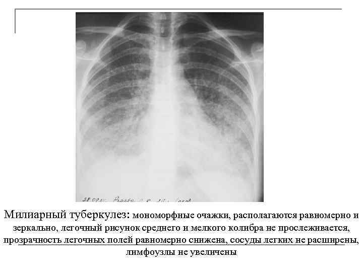 Милиарный туберкулез