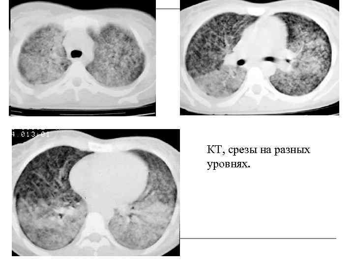 КТ, срезы на разных уровнях. 