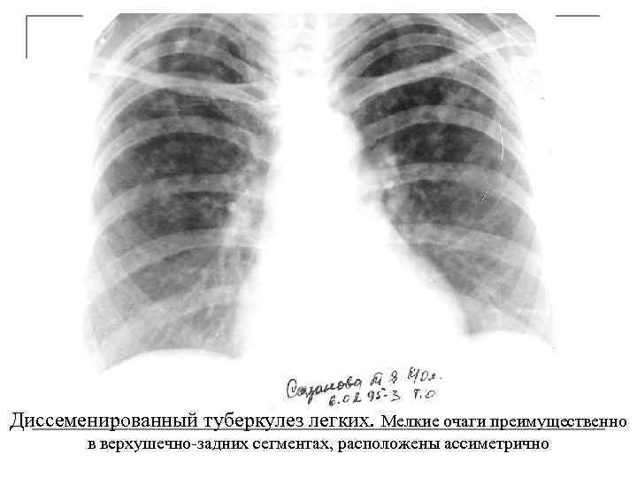 Диссеменированный туберкулез легких. Мелкие очаги преимущественно в верхушечно-задних сегментах, расположены ассиметрично 