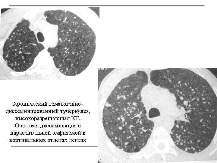 Фото кт легких при туберкулезе
