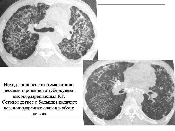 Исход хронического гематогеннодиссеминированного туберкулеза, высокоразрешающая КТ. Сотовое легкое с большим количест вом полиморфных очагов