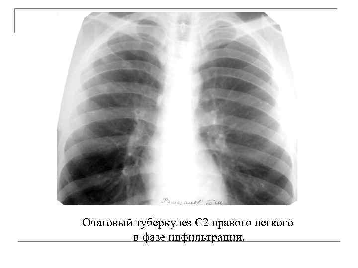 Туберкулез легких в фазе инфильтрации. Очаговый туберкулез рентген. Очаговый туберкулез в фазе инфильтрации. Очаговый туберкулез в фазе инфильтрации рентген. Очаговый туберкулез верхней доли правого легкого рентген.