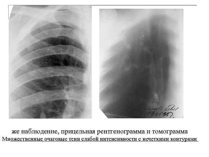 Тени средней интенсивности в легком