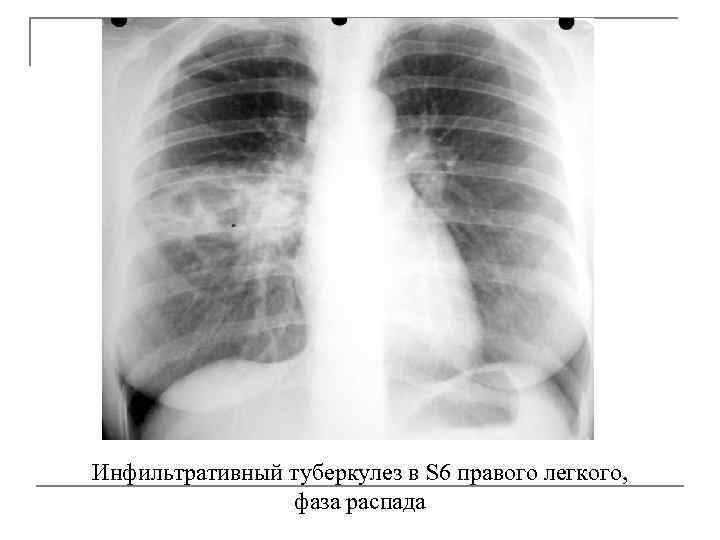 Инфильтративного в фазе распада. Инфильтративный туберкулез легкого с1-2. Инфильтративный туберкулез рентген. Инфильтративный туберкулез с распадом рентген. Инфильтративный туберкулез s6.