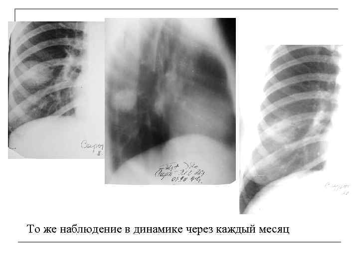 То же наблюдение в динамике через каждый месяц 