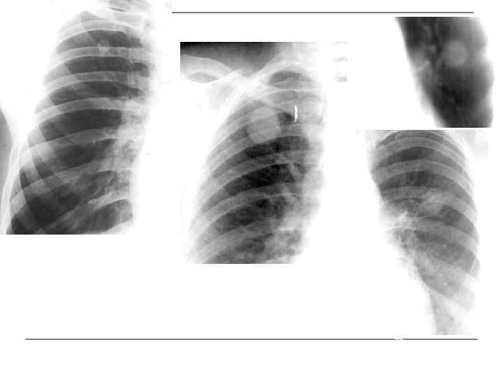 Туберкулема Хондрома Рак 