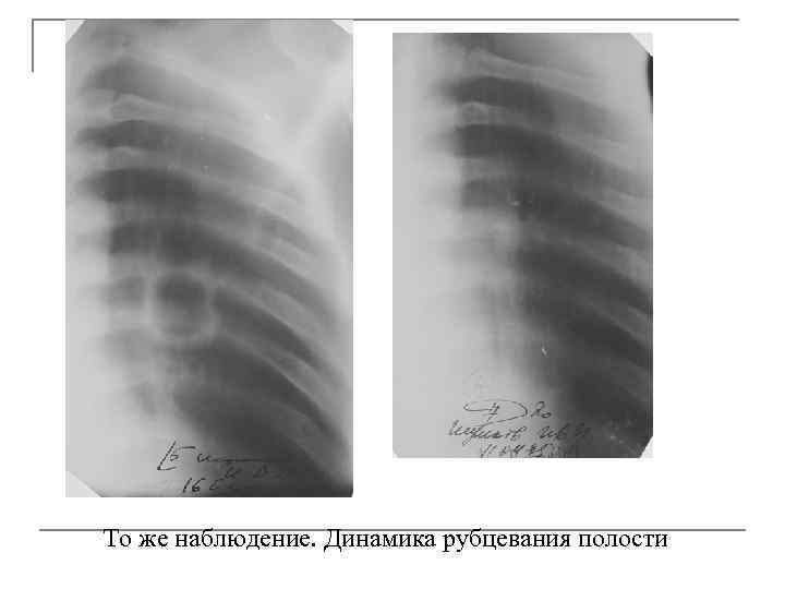 То же наблюдение. Динамика рубцевания полости 
