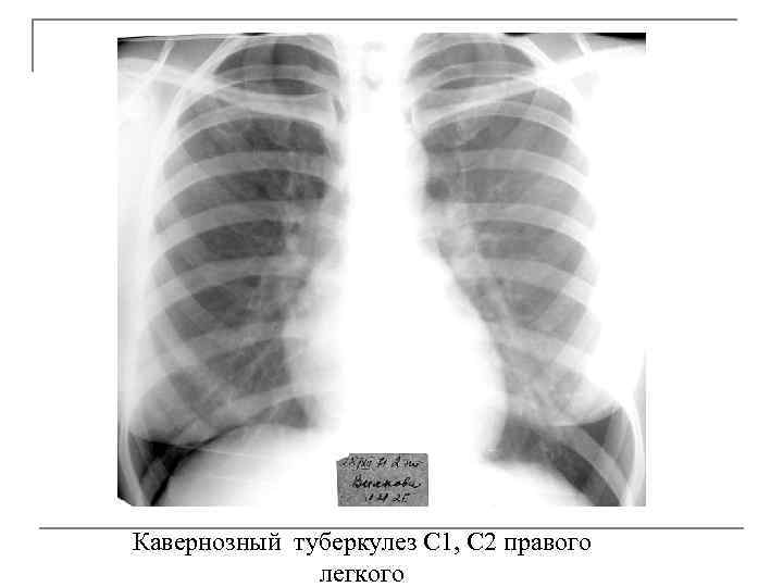 Кавернозный туберкулез С 1, С 2 правого легкого 