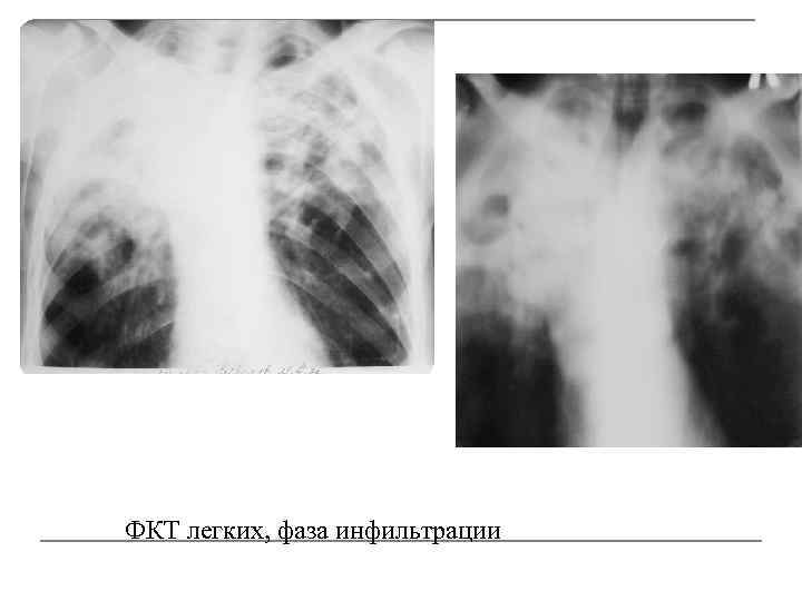 Туберкулез легких в фазе инфильтрации
