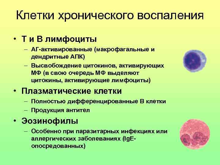 Клетки хронического воспаления • T и B лимфоциты – АГ-активированные (макрофагальные и дендритные АПК)