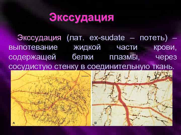 Экссудация (лат. ex-sudate – потеть) – выпотевание жидкой части крови, содержащей белки плазмы, через