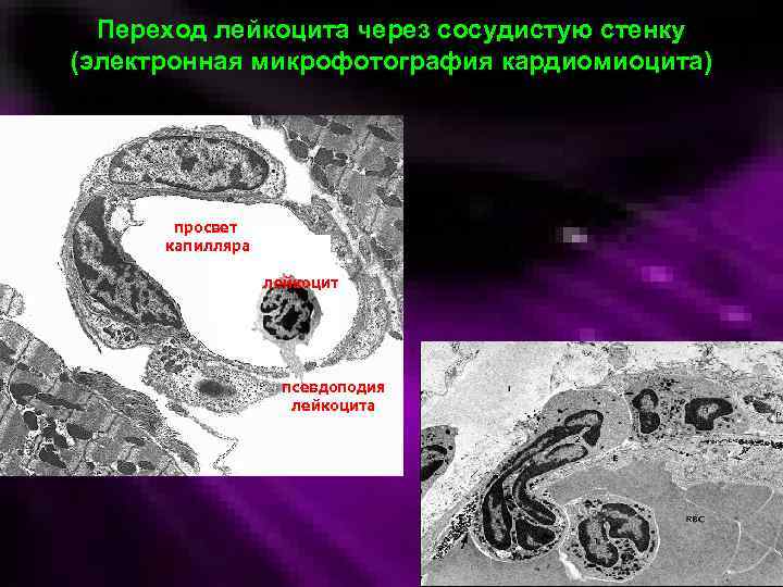 Переход лейкоцита через сосудистую стенку (электронная микрофотография кардиомиоцита) просвет капилляра лейкоцит псевдоподия лейкоцита 